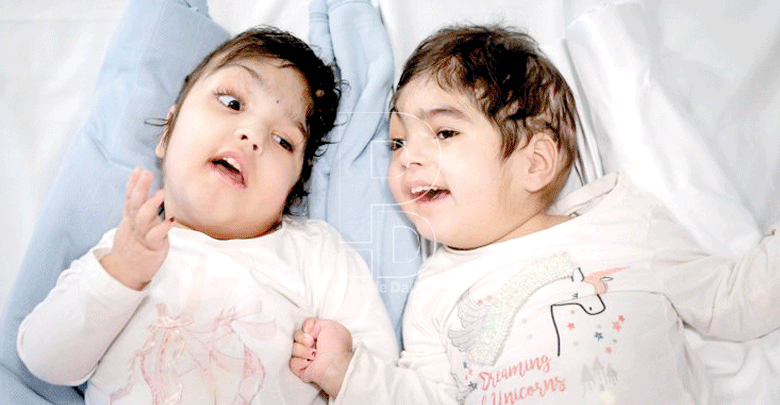 Safa and Marwa Ullah: Successfully separated conjoined twins