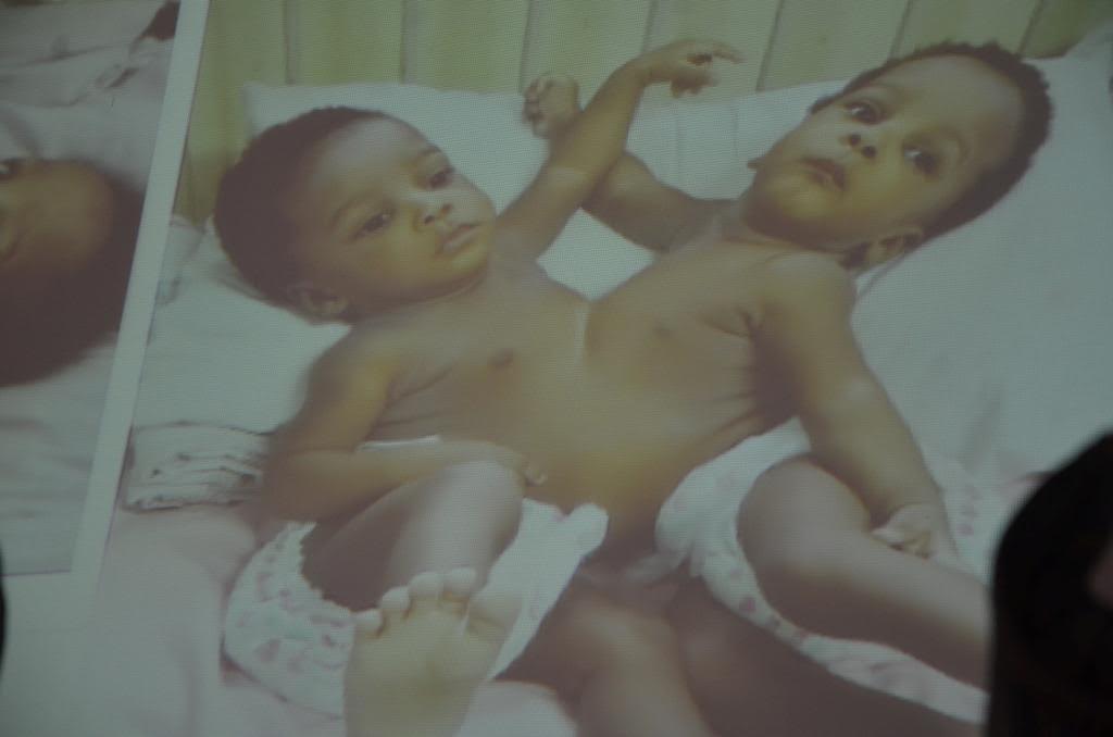 Nigeria hospital separates conjoined twins