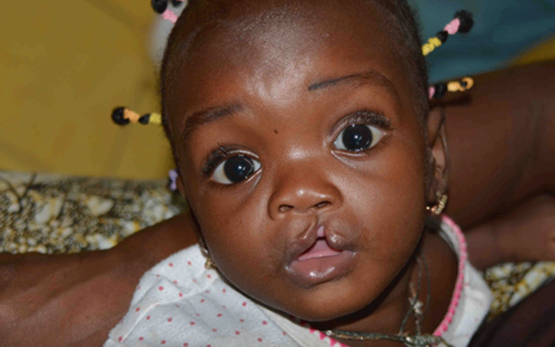 Nutrition for children with cleft lip or palate