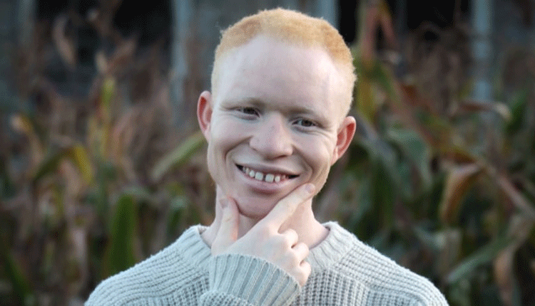 Rising above skin condition: Jairus Ongetta was crowned the first Mr Albinism Kenya in 2016