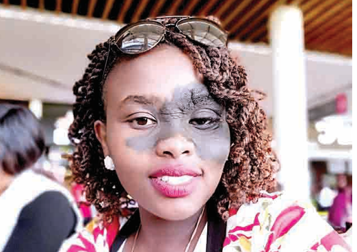 Peris Wanjiku: I wear my birthmark with pride