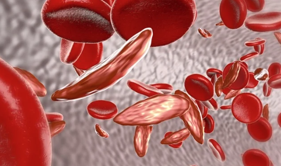 Kenya among African countries tagged for new sickle cell disease app roll out