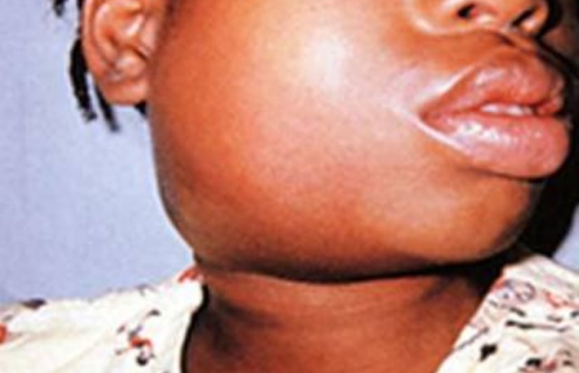 Uphold hand hygiene to stop spread of mumps, says official