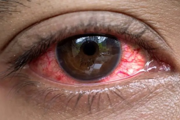 Gov’t on high alert as ‘red eye’ disease spreads to Nairobi, Kisii