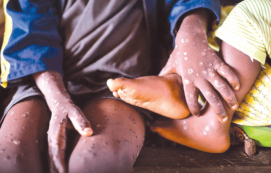 State traces paths of persons likely to have contracted Mpox