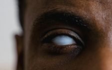 Close-up Shot of a Blind Eye. PHOTO/Pexels