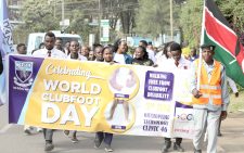 One in 10 children born in Kenya have clubfoot