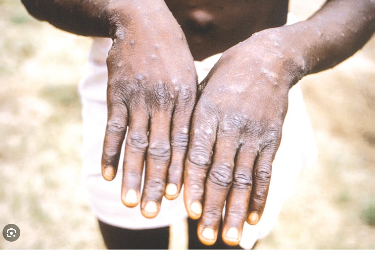 Mombasa confirms two Mpox deaths as cases rise  