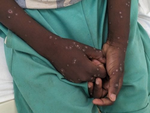 A patient diagnosed with Mpox. PHOTO/@UNICEF_CAR/X