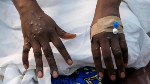 A patient displaying symptoms of Marburg virus disease. PHOTO/@NPHIKenya/X