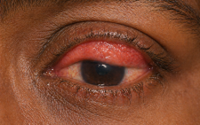 Facts about Trachoma, a leading infectious cause of blindness worldwide